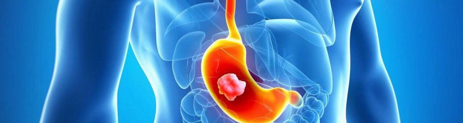 Виразка шлунку. Що потрібно знати?